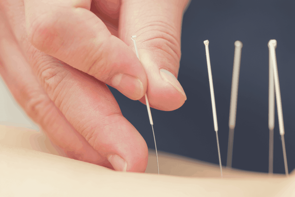 sciatica acupuncture
