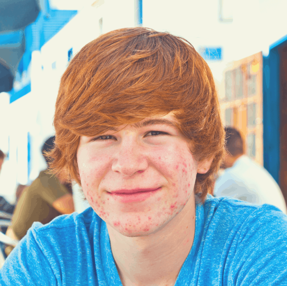 teenager sitting in public with facial acne