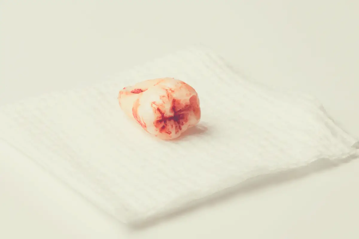 picture of an extracted tooth