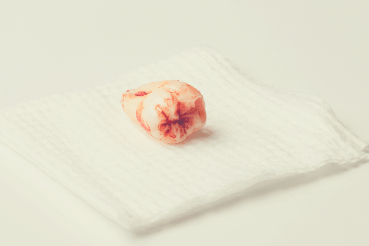 picture of an extracted tooth