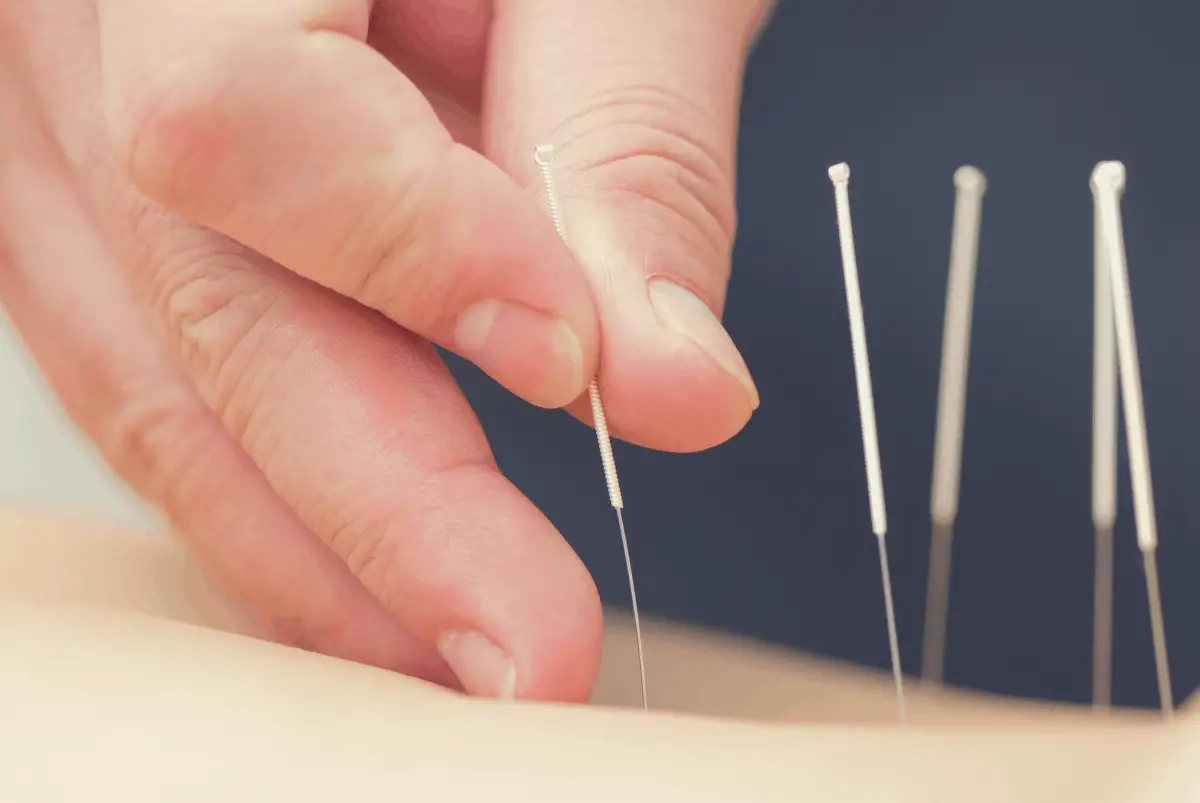 patient undergoing acupuncture