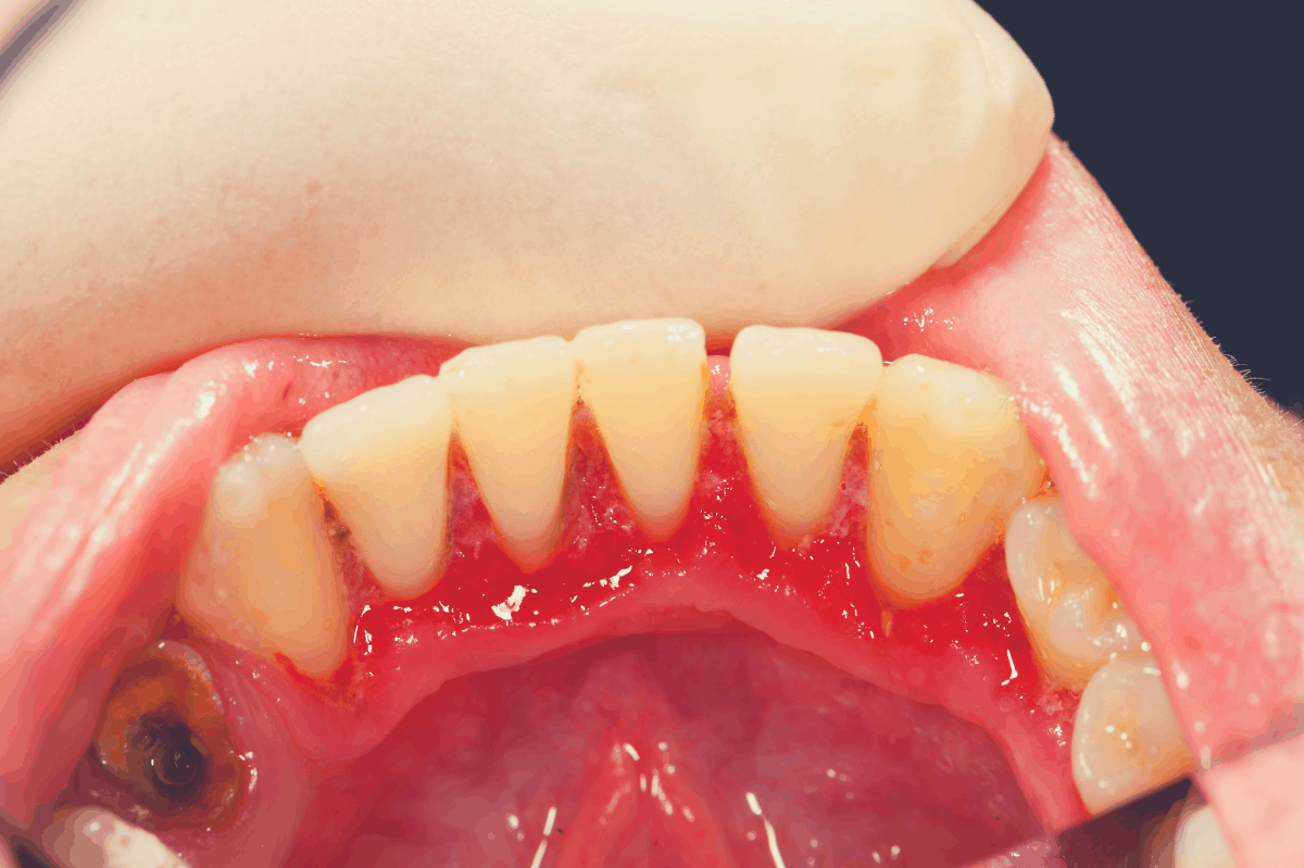 patient with discolored and rotten teeth