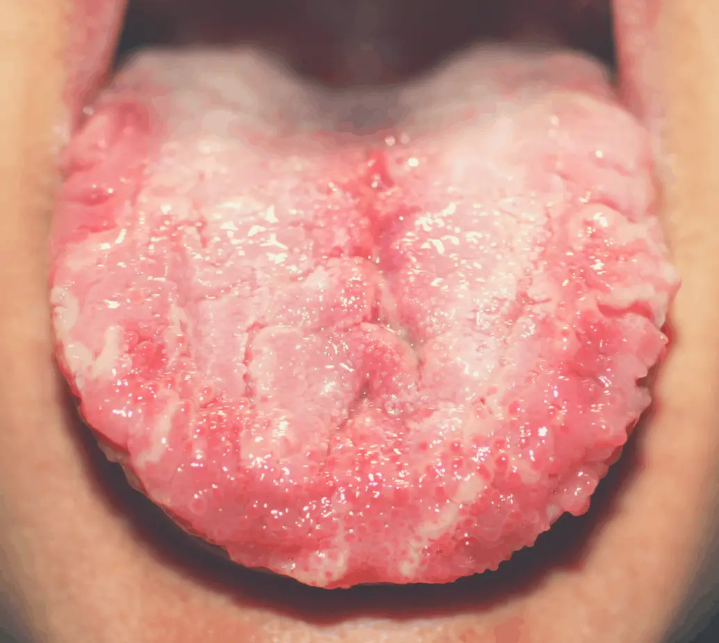 a discolored and cracked tongue