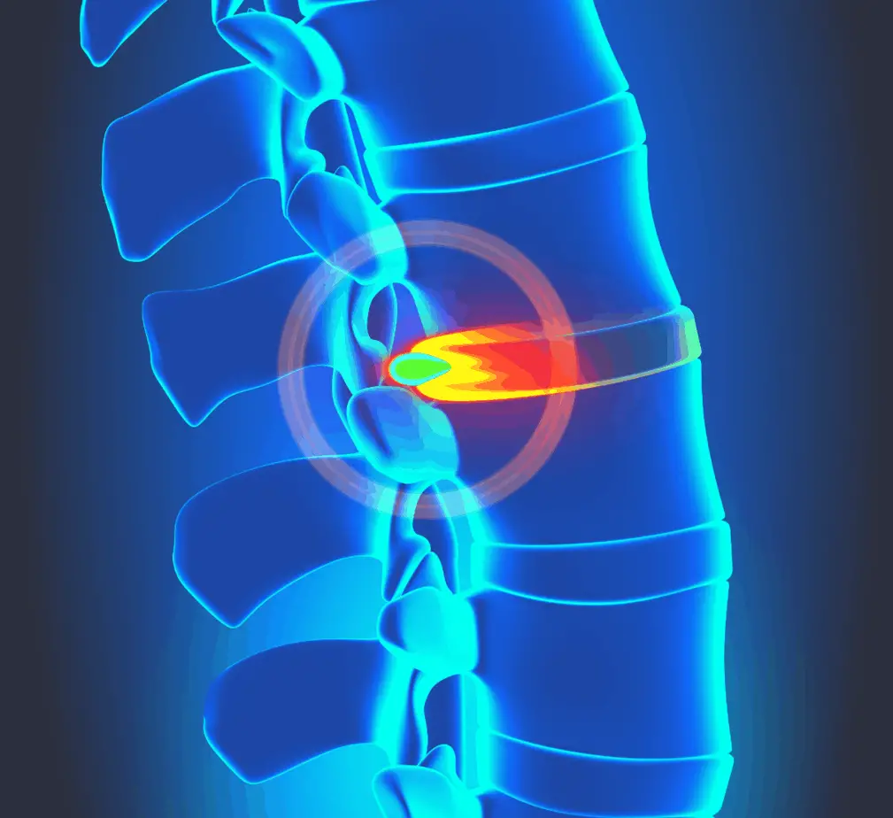 graphic illustration of a herniated disc